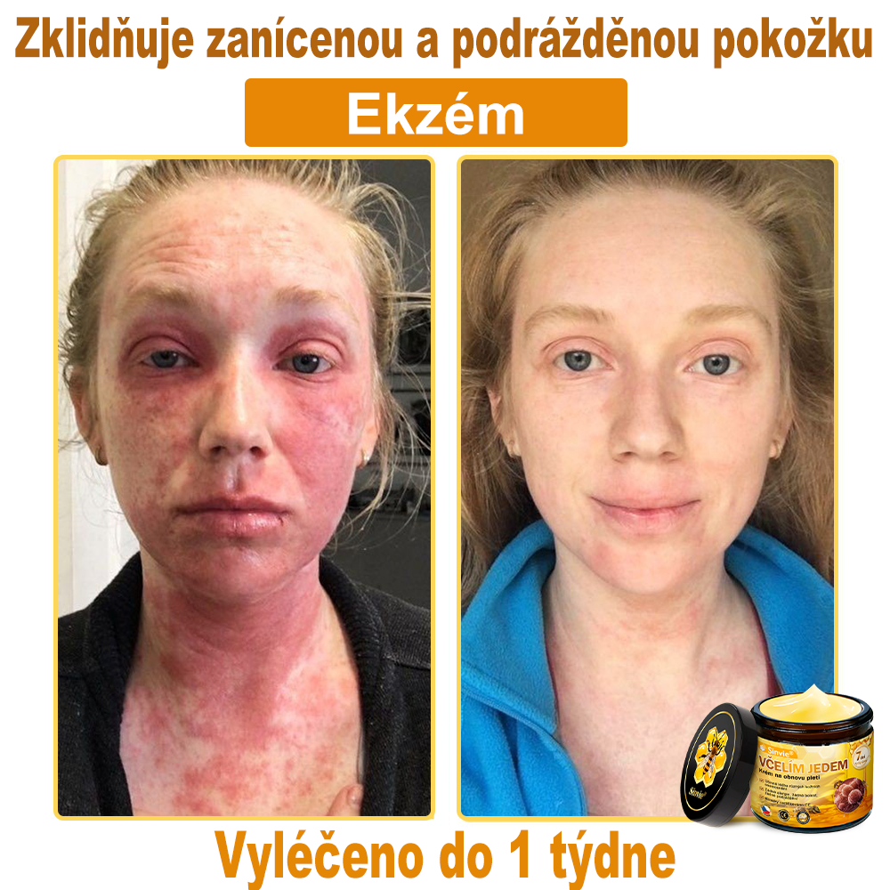 🐝🐝 Sinvie® Krém na obnovu pleti s včelím jedem 👨‍⚕ Doporučeno dermatology ✅CE schváleno - 50ml