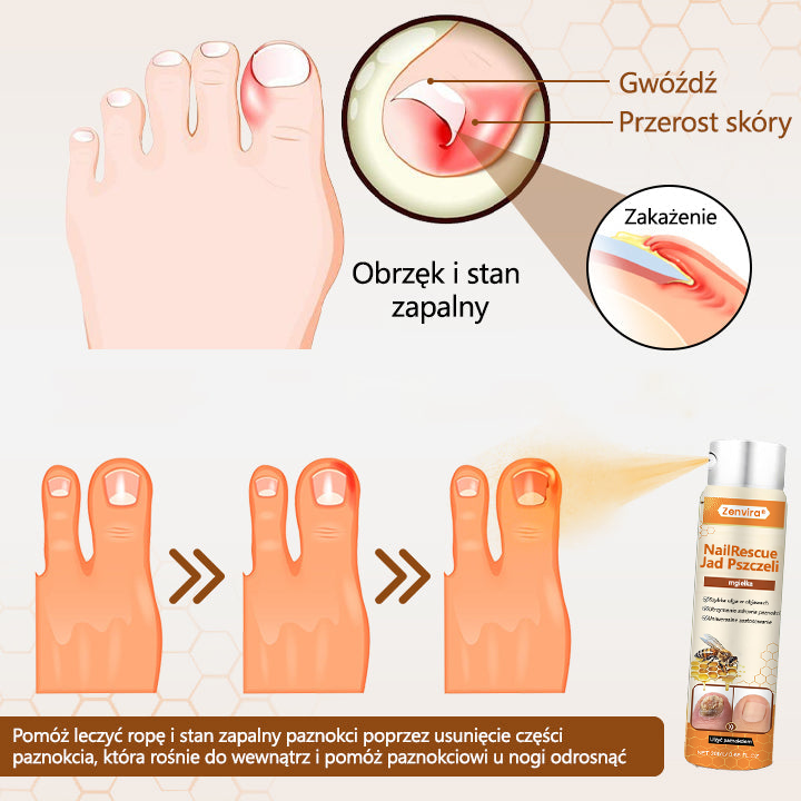 【Doporučeno odborníky】💛💛Zenvira® NailRescue Přírodní Sprej — ✅ Prokázaná účinnost proti lámavosti a žloutnutí nehtů během 7 dní!